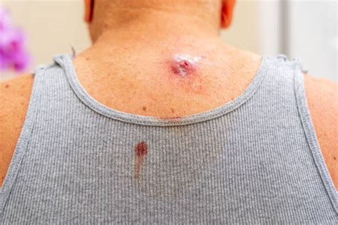 cisti sebacea come farla assorbire